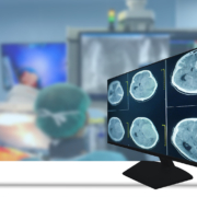 brain tumour treatment - CT Scan brain