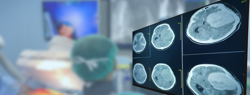 brain tumour treatment - CT Scan brain