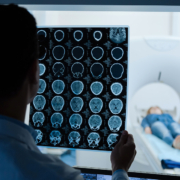 Gamma Knife surgery - brain scan