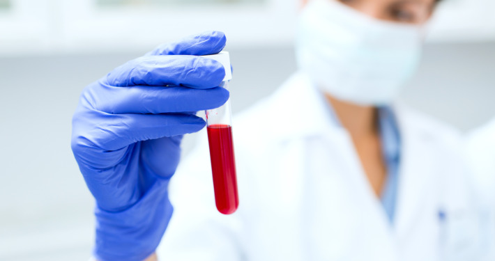 gamma knife surgery - scientist holding test tube with blood sample