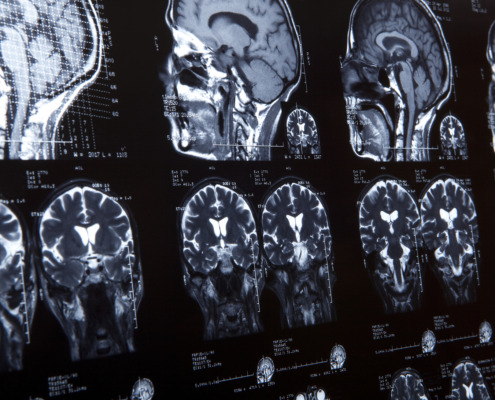 Gamma Knife Surgery - MRI of human brain