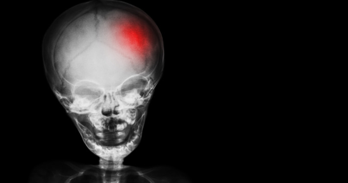 arteriovenous malformation treatment - film x-ray skull