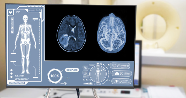meningioma treatment - parenchymal hemorrhage
