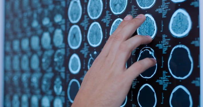 gamma knife radiosurgery - Close up of a doctors hand pointing at the brain