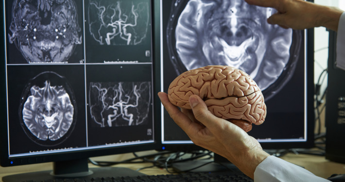 brain metastases treatment - Human brain model on doctor hand