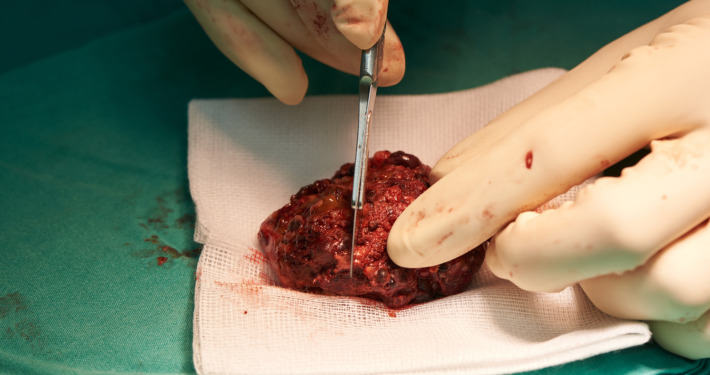 cavernoma treatment - Surgeon holding and cutting abnormal vascular tissue