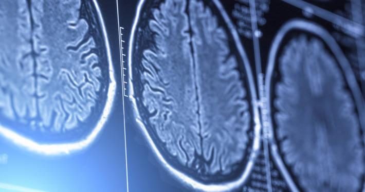 gamma knife radiosurgery - magnetic resonance image of head or scull and brain scan