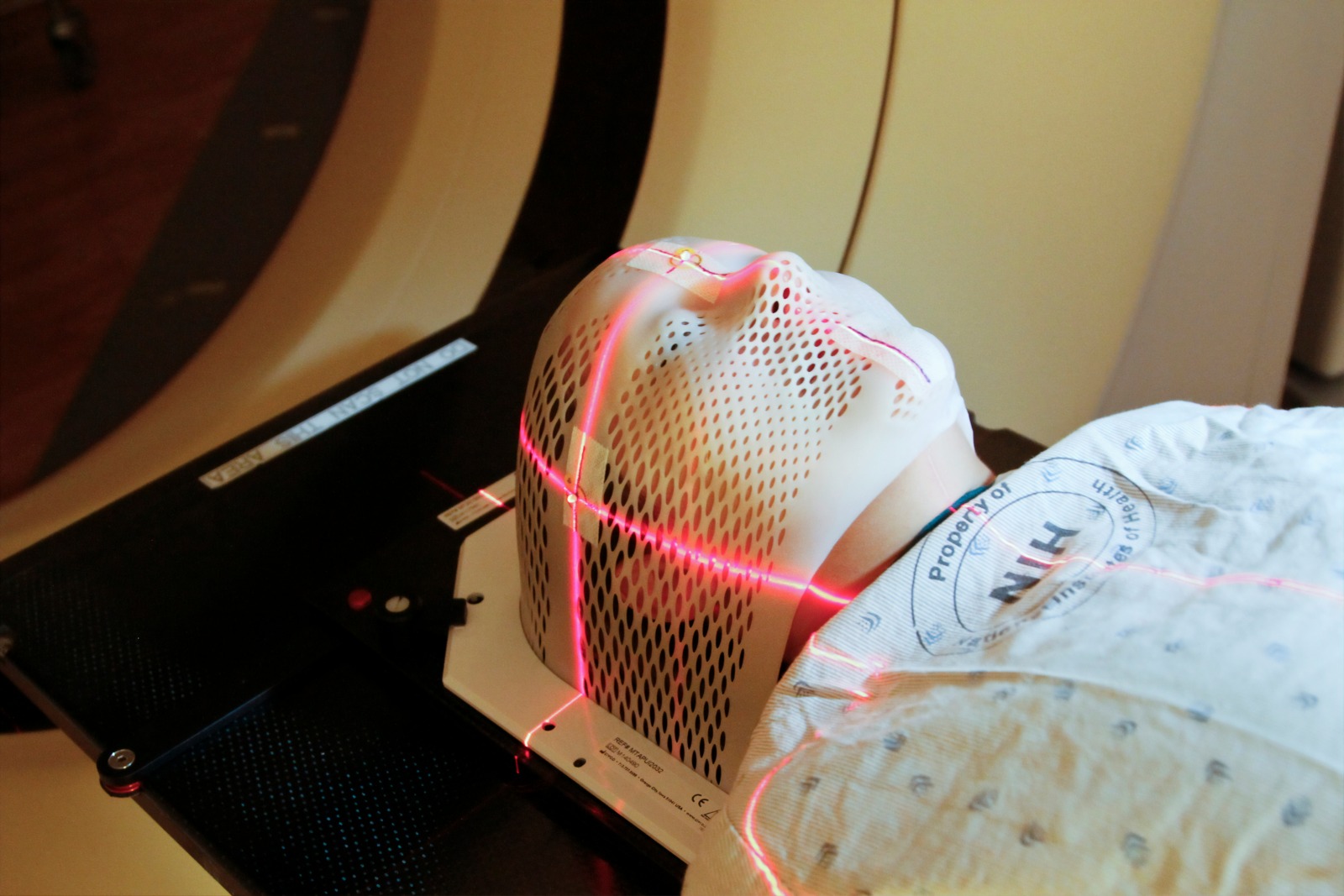 gamma knife radiosurgery - radiotherapy